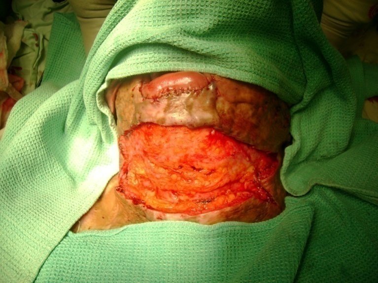 Burn reconstruction surgical opening