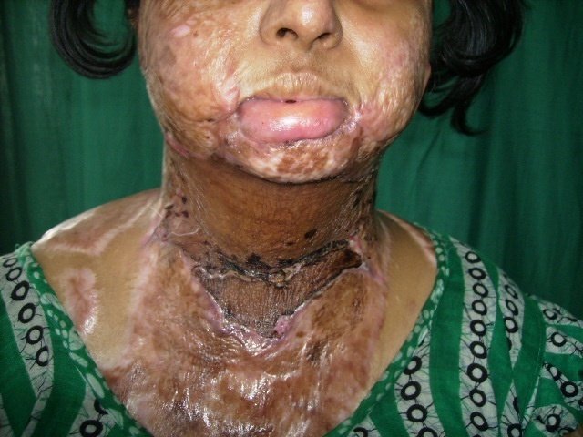 Burn reconstruction healing after skin graft application