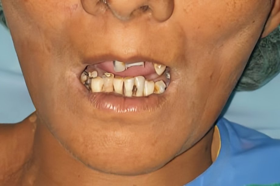 Mouth not openable beyond 10 mm