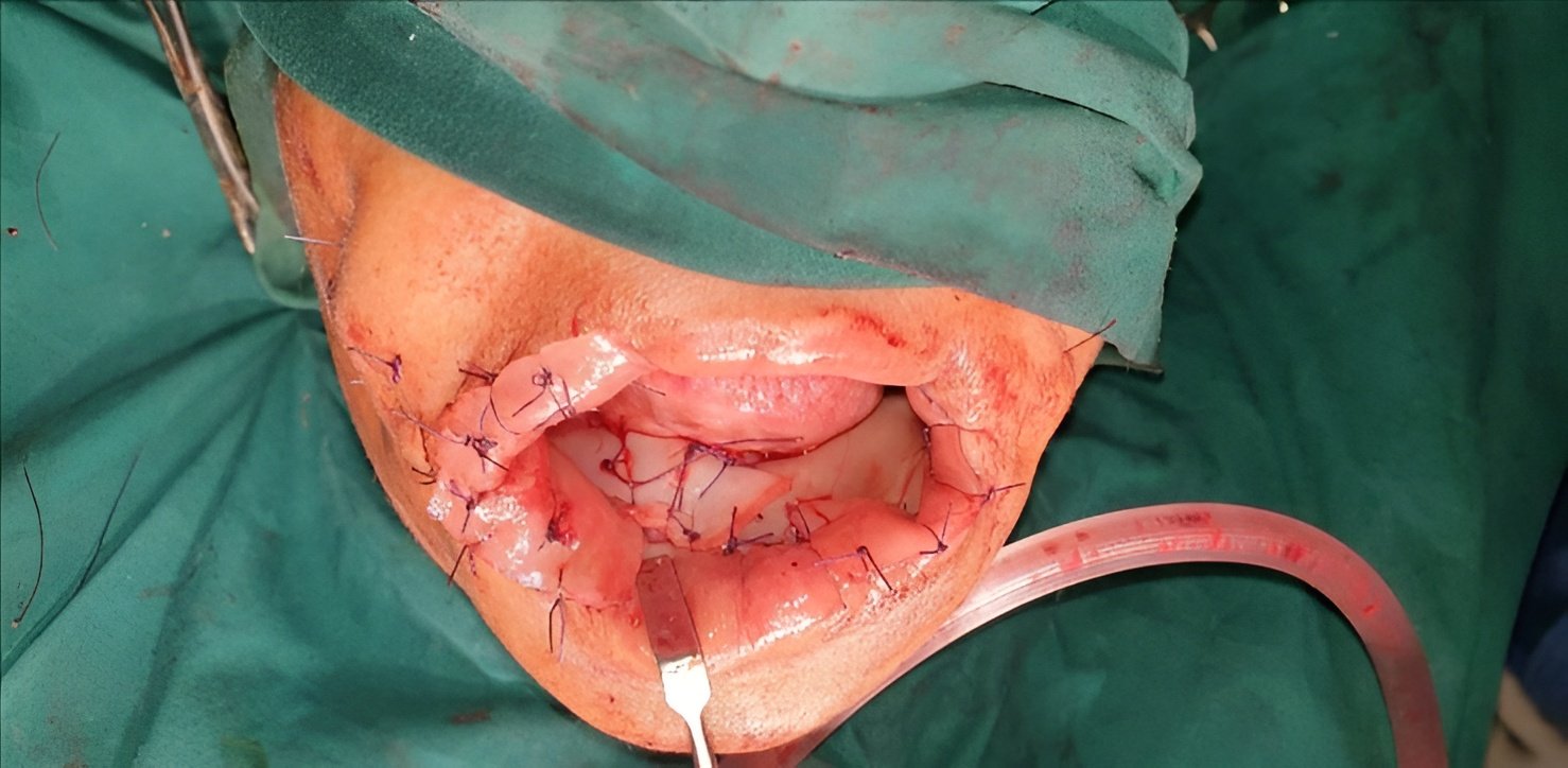 Surgicoll-Mesh secured using sutures