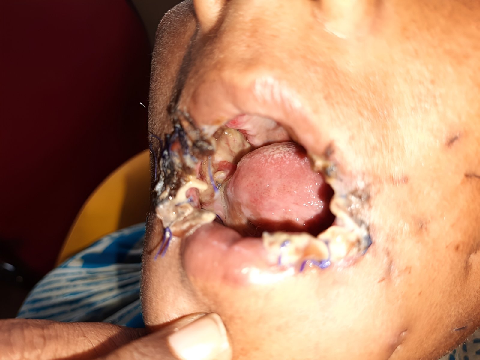 Mouth opens beyond 20 mm – Day 14