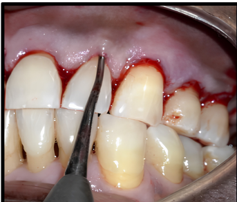 Sulcular incision