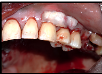 Graft adaptation