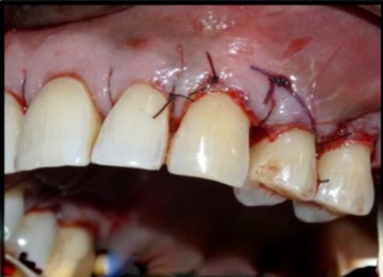 Recipient site suturing with sling sutures