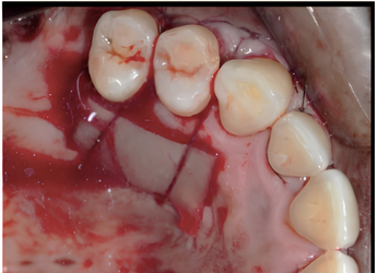 Bovine collagen sheet dressing protecting donor site