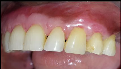 2 weeks post-operative follow up
