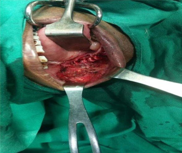 Pre-op oral cancer, surgical defect of verrucous carcinoma