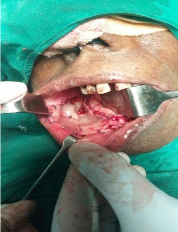 Application of Surgicoll-Mesh