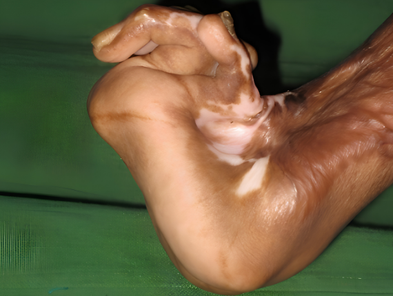 Hand deformation before surgery