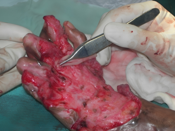 Surgical procedure Day 3