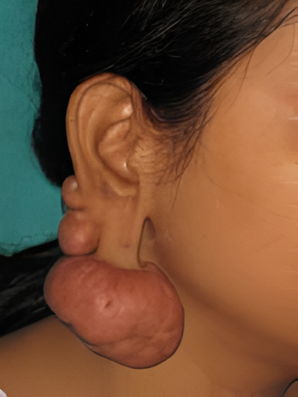 Day 0 - Keloid before surgery