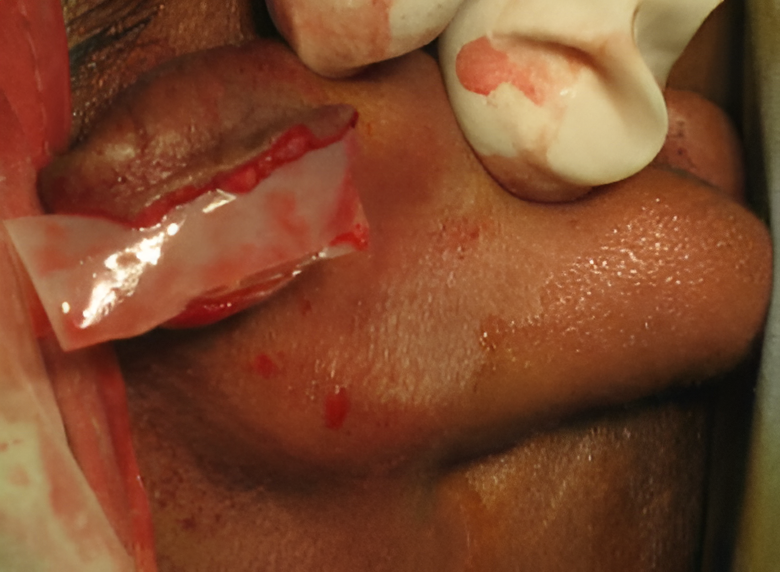 Day 0 - Keloid before surgery