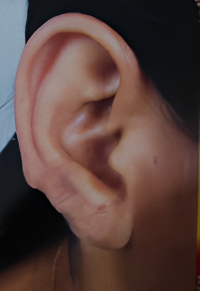 Day 0 - Keloid before surgery
