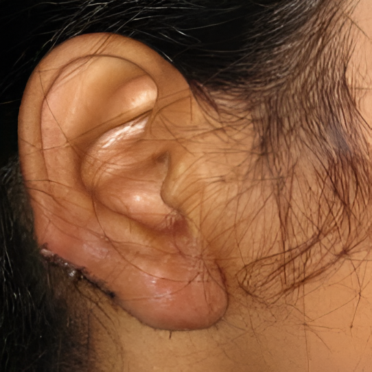Day 0 - Keloid before surgery