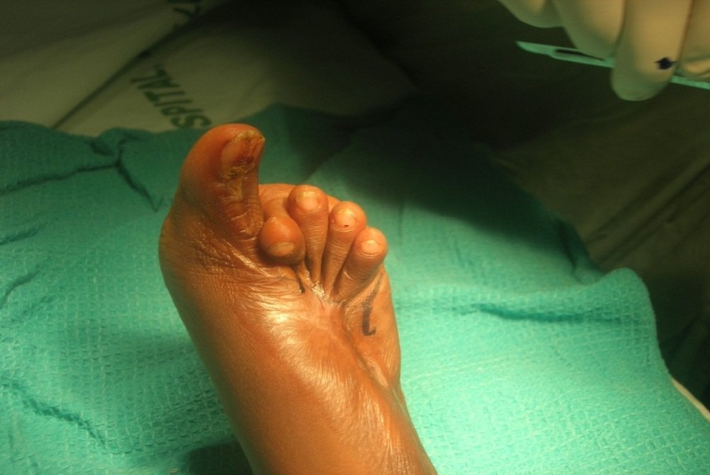 Foot before surgery, showing exposed bone injury