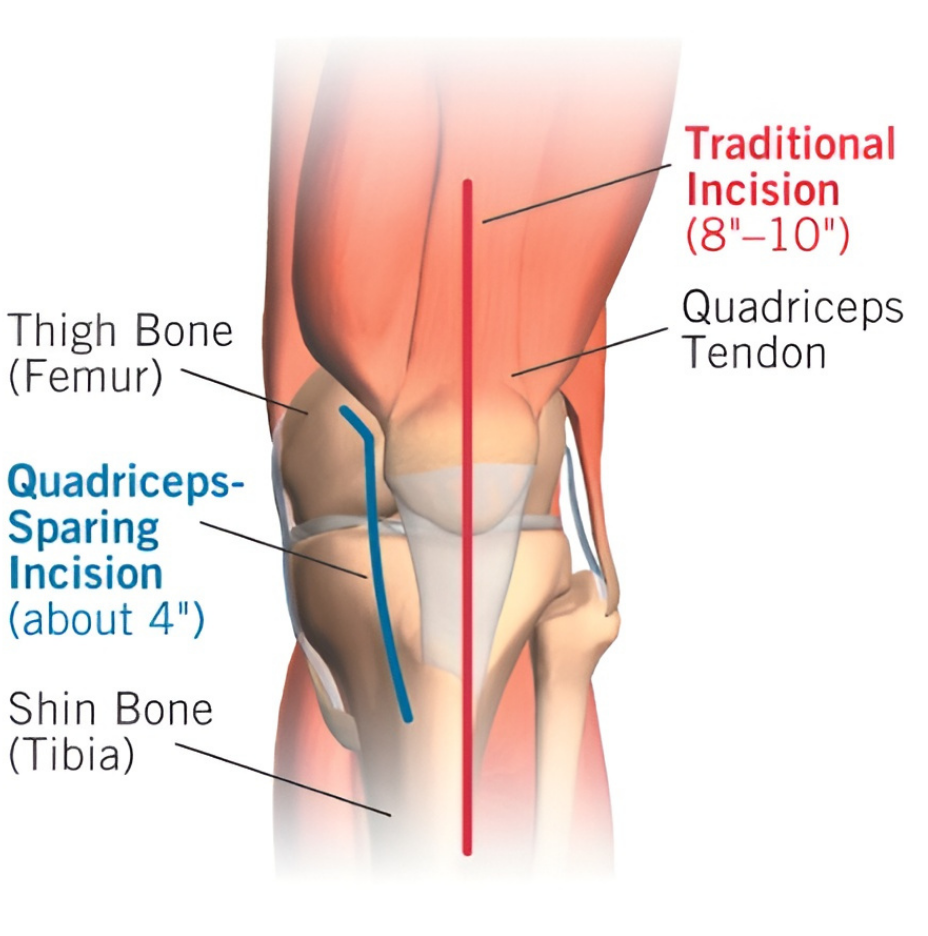 Traditional incision versus quadriceps-sparing incision on knee