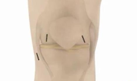 Knee joint prepared with marked insertion points