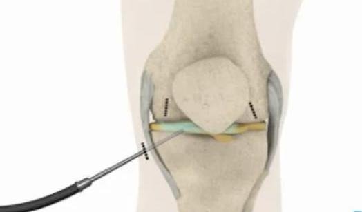 Arthroscopic instrument inserting Surgicoll-Mesh into knee joint