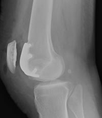 Post-operative X-ray of knee joint after repair