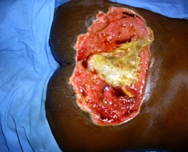 Stage 4 sacral pressure sore