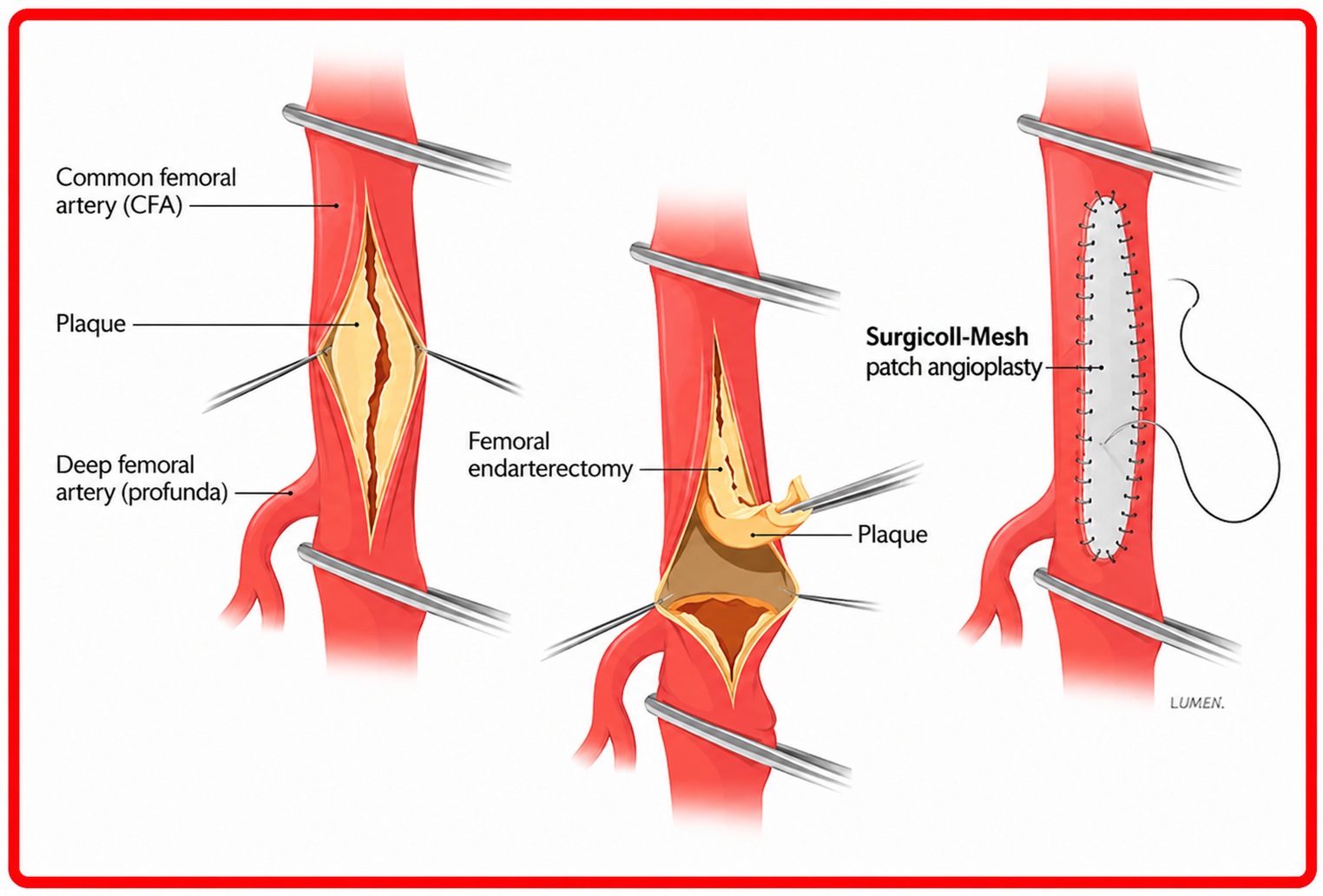 Patch angioplasty procedure, step 1