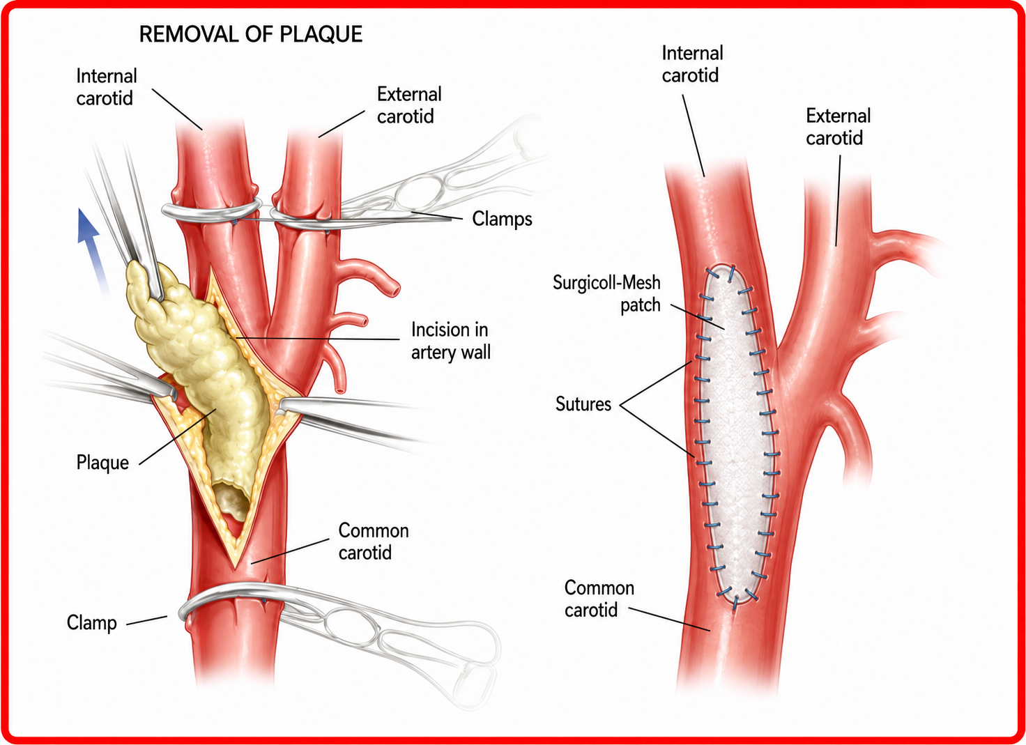 Patch angioplasty procedure, step 2
