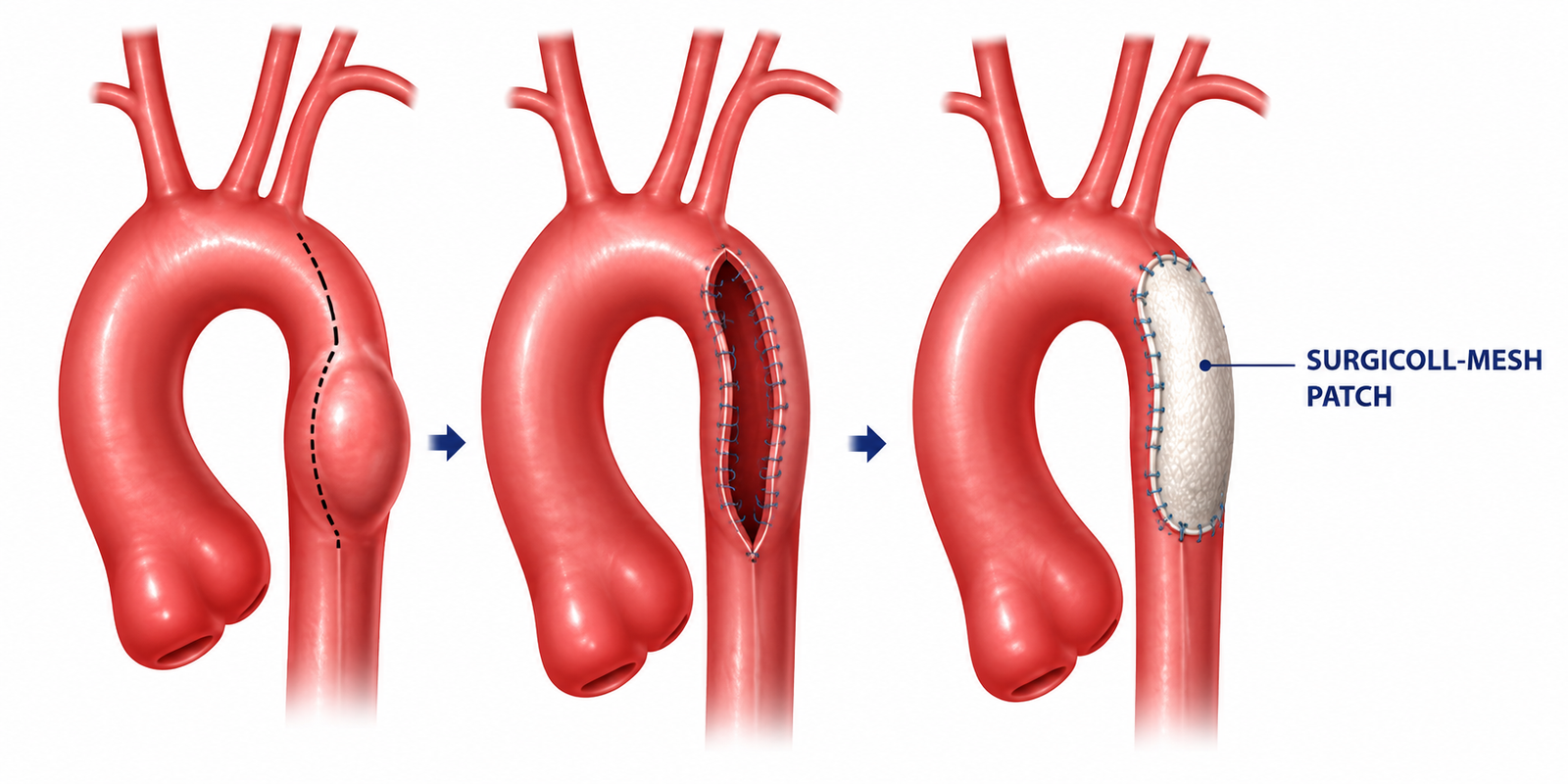 Patch aortoplasty for widening narrowed vessels