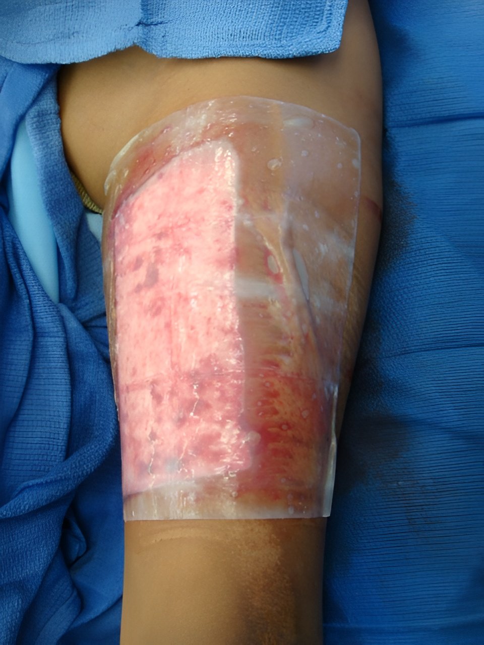 Soft tissue repair, Day 1