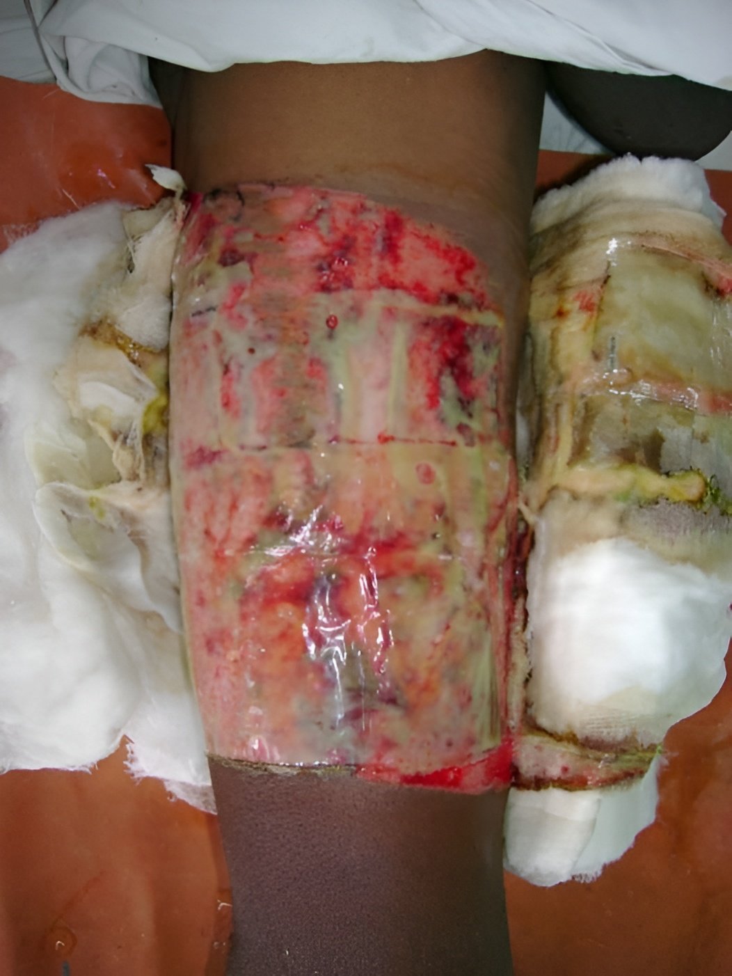 Soft tissue repair, Day 2