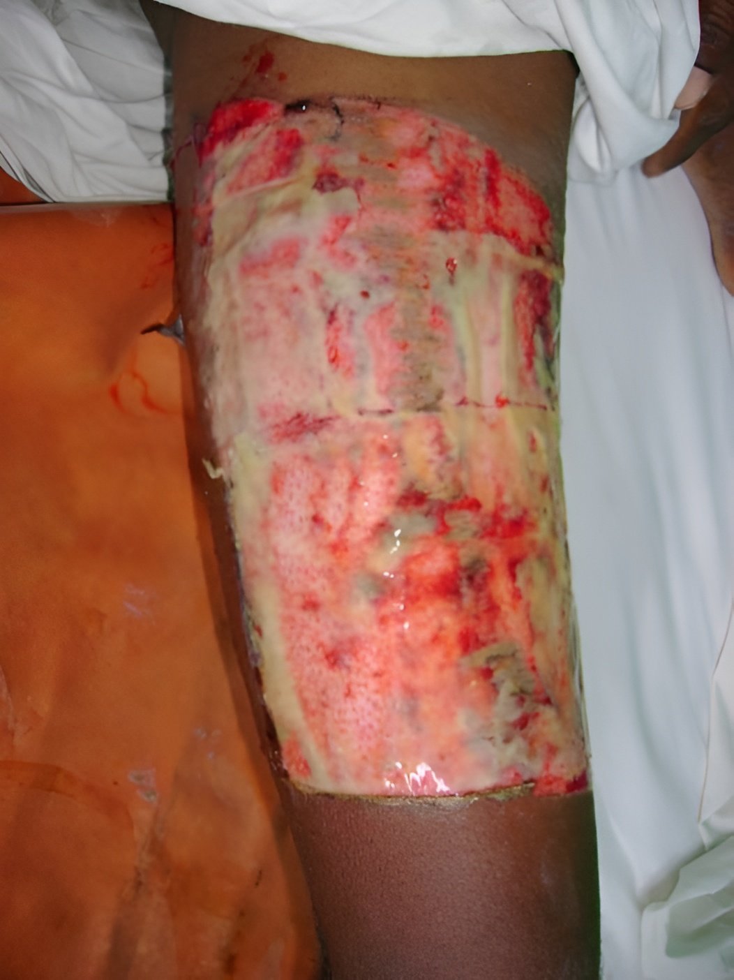 Soft tissue repair, Day 3