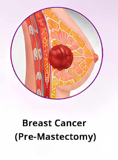 Tumor Excision