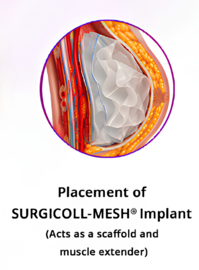 Collagen Scaffold Placement