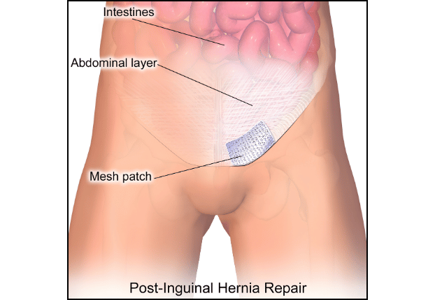 Inguinal hernia patch placement
