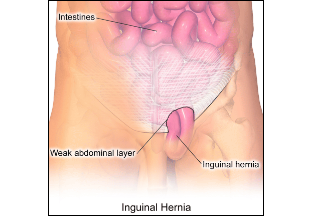 Inguinal hernia anatomy