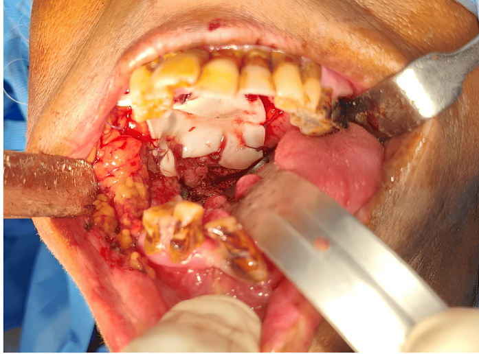Intraoral lesion status