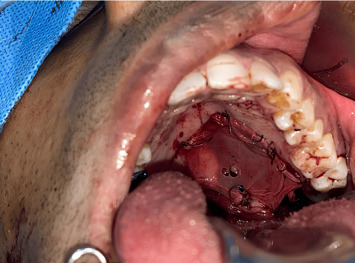 Surgical excision site
