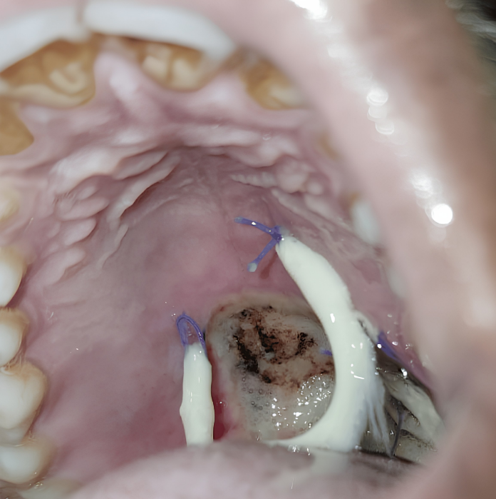 Post-operative tissue healing