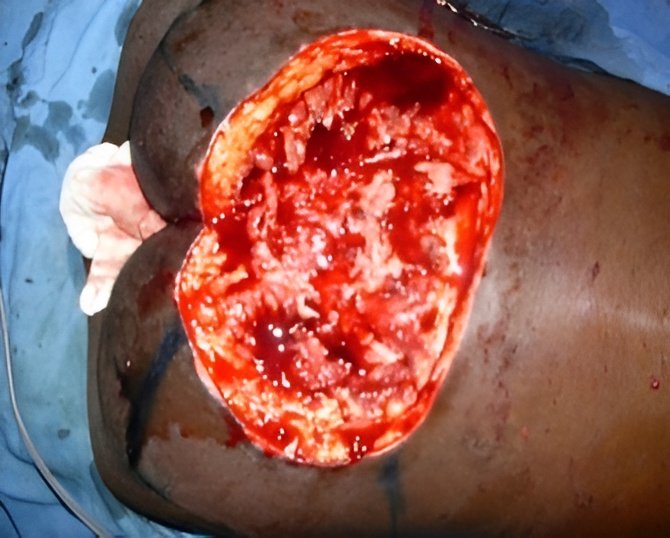 Sacral pressure sore ten days after Surgicoll-Mesh Equi application