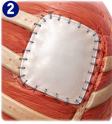Patch placement over thoracic wall defect