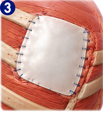 Repair process with structural support
